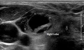Pin On Thyroide