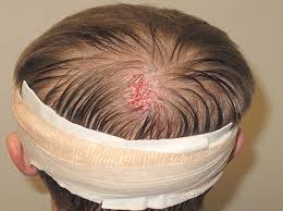Why does hair grow on my forehead? Transplanting Hair Into A Scar What You Need To Know Ht Rc