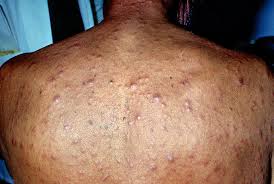 Image result for syphilis symptoms