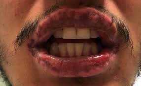 Image result for Erythema Multiforme Major