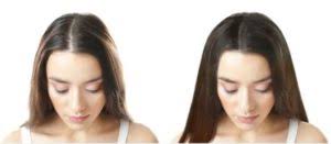 For many women, wearing a weave or extensions is a great way to switch up their hairstyle, adding length, volume, and even color. Hair Transplant Or Hair Weaving Hair Transplant In Delhi Hair Weaving