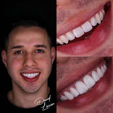 💋 Lábios Perfeitos, Confiança Total 💋 Tivemos o prazer de realizar o  preenchimento labial em uma paciente super especial, nossa amiga querida,  que confia plenamente em nosso trabalho. O resultado? Uma boca