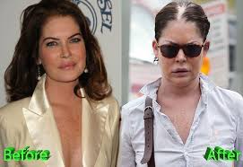 Lara Flynn Boyle Before And After Cosmetic Surgery Bad Celebrity Plastic Surgery Celebrity Plastic Surgery Bad Plastic Surgeries