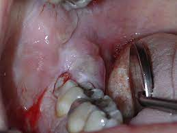 Pathology Associated With The Third Molar Oral And Maxillofacial Surgery Clinics