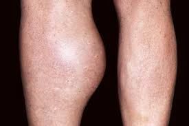 This is their first choice to heal quickly and completely from even the worst injuries. Why Does My Calf Muscle Hurt