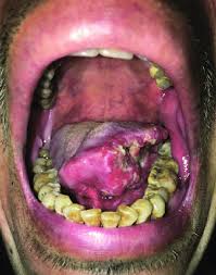 Image result for cancer of tongue