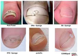 Image result for mykoza nehtů