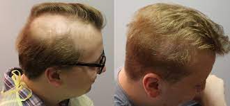With radiation therapy, hair loss may or may not be permanent and is dose and site dependent. Hair Transplant Restoration For Radiation Therapy Fallon Hair Restoration