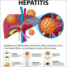 Image result for hepatitis symptoms