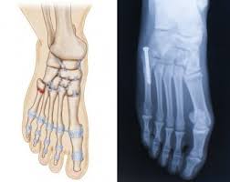 Do you have a jones fracture of the 5th metatarsal? Jones Fracture Symptoms Treatments Surgery Recovery