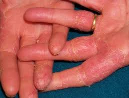 Image result for dermatitis contacta allergica