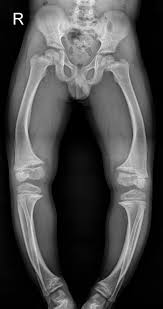 Image result for Rickets