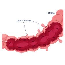 Image result for Diverticulitis