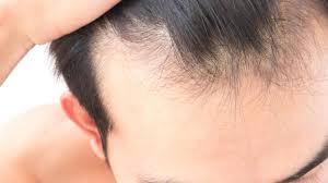 A poor immune system may also increase your chances of a bacterial or fungal infection on the scalp, both of which can prevent your follicles from producing healthy hair. From Smoking To Stress And Your Diet Why Your Hair Is Thinning And How To Stop Bald Patches