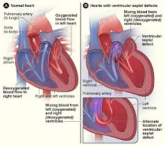 A disease is a particular abnormal condition that negatively affects the structure or function of all or part of an organism, and that is not due to any immediate external injury. Congenital Heart Defect Wikipedia