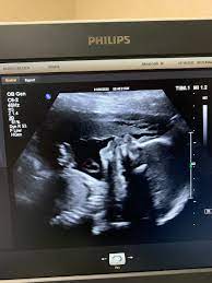 Babies Head Measuring Small May 2020 Babies Forums What To Expect