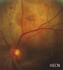 Your treatment plan will depend on the type of thyroid cancer you have and how far it has spread. Thyroid Cancer Metastasis New York Eye Cancer Center