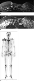 The stage describes the size of the cancer and how far it has spread, and is used to. 47 Year Old Female With Left Breast Cancer And Clavicle Metastasis A Download Scientific Diagram
