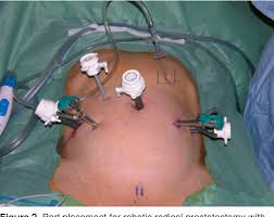 Furthermore, major vascular structures are distant from palmer's point with the interposition of other organs. Primary Left Upper Quadrant Palmer S Point Access For Laparoscopic Radical Prostatectomy Semantic Scholar