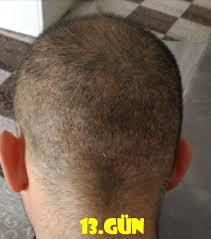 18 Haziran 2018 Yas 31 2987 Greft Sac Ekimi Cilinichair Izmir