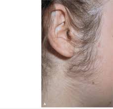 Telogen effluvium is a condition where the hair remains in the telogen (natural shedding) phase of the growth cycle. Disorders Of Hair Follicles And Related Disorders Fitzpatrick S Color Atlas And Synopsis Of Clinical Dermatology Seventh Edition