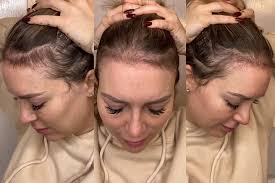 Get More Hair: My Hair & Eyebrow Transplant In Turkey