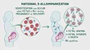 Image result for Rh Sensitization