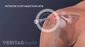 Image result for Shoulder Injection