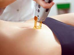 Choose an option 1 session 3 sessions 5 sessions. Abdomen Line Laser For Women Clinica One