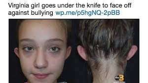 Virginia girl, 11, bullied for 'elf ears' has plastic surgery