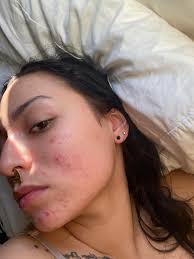 Min utveckling efter 3 år med cystisk akne! Ser äntligen ljuset. Rutinen  finns i kommentarerna : r/tretinoin