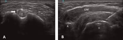 Image result for Biceps Tendon Injection
