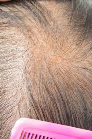 During telogen, it remains dormant. Thinning Hair Causes Types Treatment And Remedies