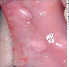 Plexiform fibroma sclerosing fibroma osseous fibroma buccal mucosa cancer buccal mucosa lump buccal mucosa lichen planus buccal mucosa ulcer. Figure 1 From Myofibroma Of The Oral Mucosa A Case Report Semantic Scholar