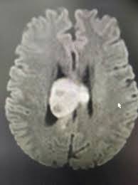 Pin On Brain Ct And Mri Images