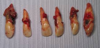 Image result for Tooth Extraction