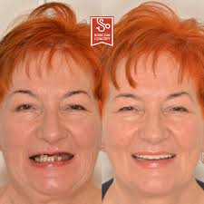 Dopiero mieliście możliwość podziwiać metamorfozę uśmiechu Naszej  Pacjentki, a dzisiaj macie możliwość posłuchać jak nowy uśmiech zmienił jej  życie i dlaczego zdecydowała się na swoje trzecie zęby bez sztucznych  dziąseł 🤫🤩 W