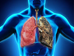 Image result for lung cancer diagnosed as asthma"