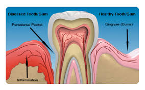 Brush up on your brushing technique. Dental Gum Treatment Alliance Dental Center Dentists In Jackson Heights Queens Ny 11372 718 424 7100
