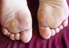 Hope the top wart remover recommendations above can help you make an educated decision in. Symptoms Causes And Treatment For Plantar Warts