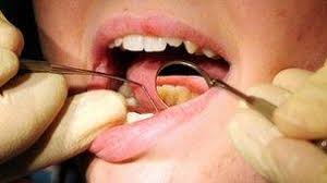 The appearance of feline oral cancer can vary significantly, depending on the type of cancer and how far advanced the cancer is. Mouth Cancer Rising Among Young Bbc News