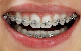 Adalah jenis bracket yang menempel pada gigi geraham besar/ molar. Bagaimana Cara Kerja Behel Gigi Galena