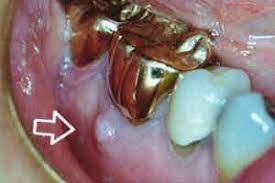 Que Es Una Fistula Dental