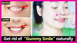 May 08, 2018 · here's some of the ways gummy smile can be fixed: Just 4 Steps How To Get Rid Of Gummy Smile Naturally No Braces Or Surgery Gummy Smile Exercises Youtube