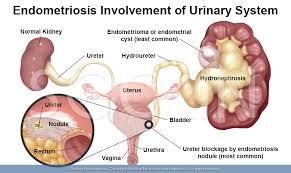 I know it has to be my kidney. Endometriosis Of The Kidneys What You Need To Know About This Rare Co