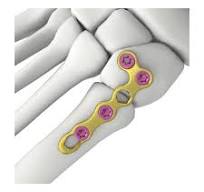 Ankle Foot Locking Plate System,Medical Device & Implants ...