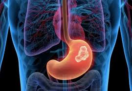 Pain in your stomach or breastbone. Stomach Cancer Treatment In Thane Stomach Cancer Sugeon In Thane Mumbai