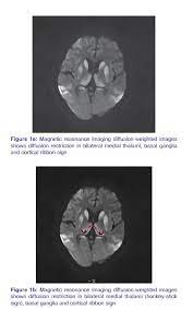 Pulvinar Hockey Stick Sign In Creutzfeldt Jakob Disease Venkatesan Ep Ramadoss K Med J Dy Patil Univ