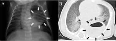 Image result for Lung Abscess