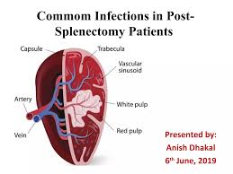 Image result for Overwhelming Postsplenectomy Infection